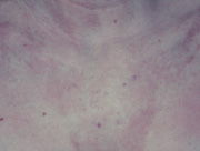 Dermatitis piel de contacto