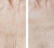 Mesoterapia facial: antes y después