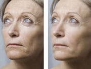 Mesoterapia facial: antes y después