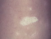 Psoriasis