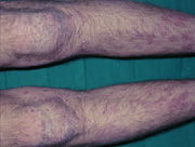 Psoriasis
