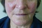 Tratamiento de la Rosácea para el rostro en nuestra clínica de dermatología estética situada en Barcelona