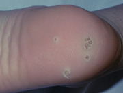 Verrugas del papiloma humano